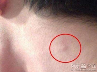 腹部溝酸脹是淋巴發炎嗎_腹股溝淋巴結觸診_腹股斜溝疝要不要緊